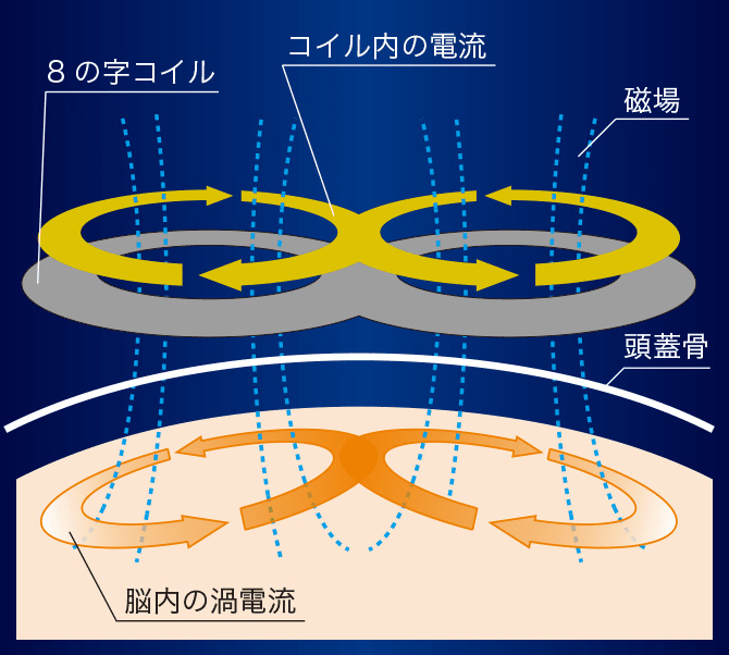 TMS治療（磁気刺激治療）の原理とメカニズム